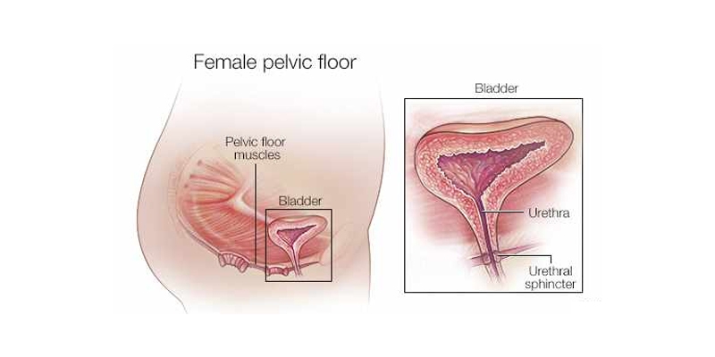 Female-Urinary-Incontinence